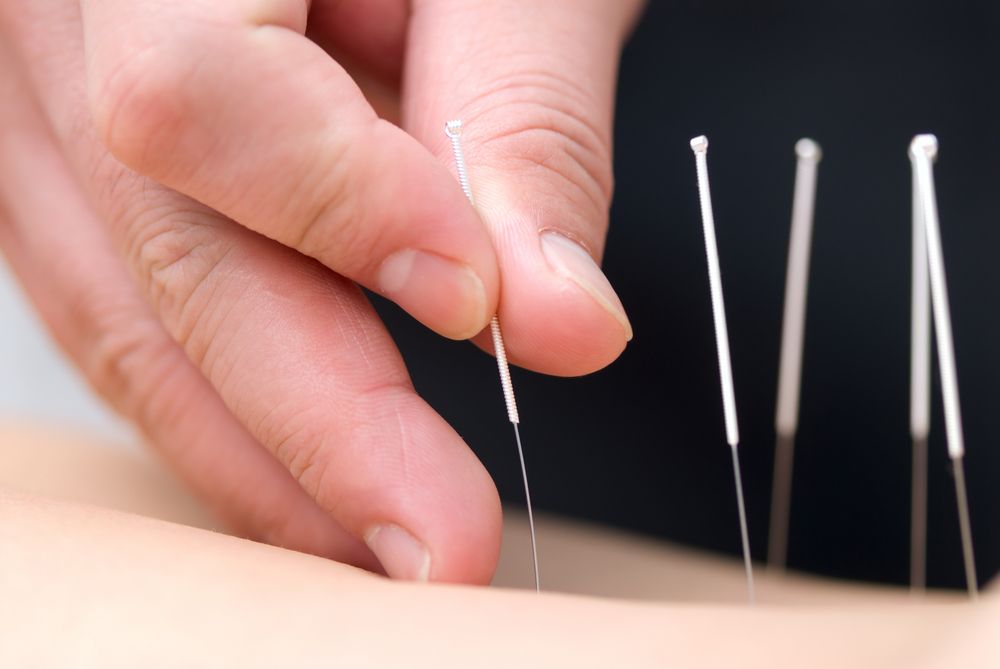 Acupuncture, Chiroaxion.com